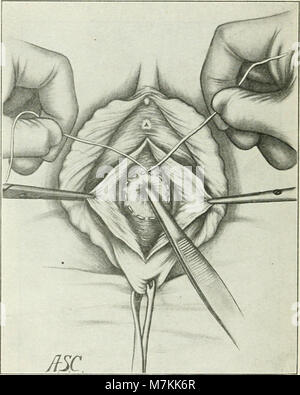 A manual of gynæcology and pelvic surgery, for students and practitioners (1916) (14581018059) Stock Photo