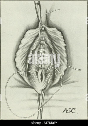 A manual of gynæcology and pelvic surgery, for students and practitioners (1916) (14765299744) Stock Photo