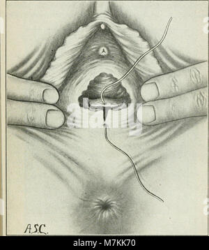 A manual of gynæcology and pelvic surgery, for students and practitioners (1916) (14767640815) Stock Photo