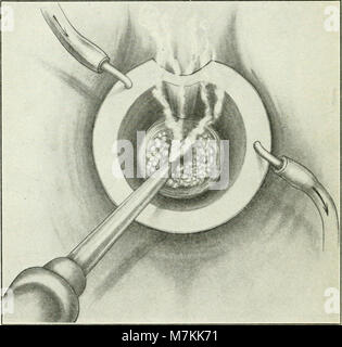 A manual of gynæcology and pelvic surgery, for students and practitioners (1916) (14767690385) Stock Photo