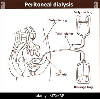 peritoneal dialysis are both used to treat kidney - vector illustration ...