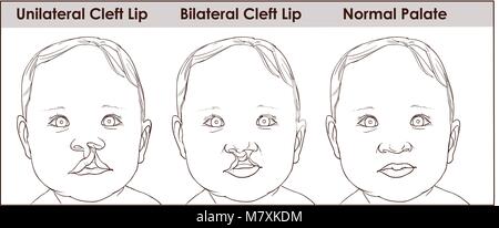 illustration of a cleft palate in a child. plastic surgery. reconstruction of the upper palate Stock Vector
