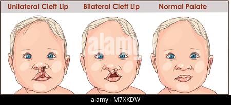 illustration of a cleft palate in a child. plastic surgery. reconstruction of the upper palate Stock Vector