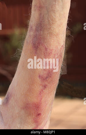 Bruising (hematoma) caused by internal bleeding as a result of a blood test having been performed. Stock Photo