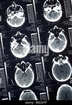 CT Scan of a Human Male Brain, Close Up Stock Photo