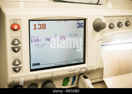 horizontal image of Cardiotocography , fetal heartbeat monitor, also electronic fetal monitor.  Recording on graph paper Stock Photo
