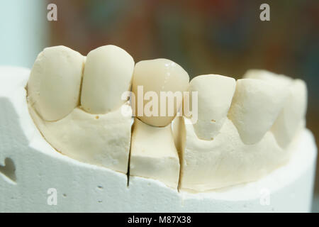 Gypsum Stomatologic human jaws. Ceramic-metal crown on plaster model Stock Photo