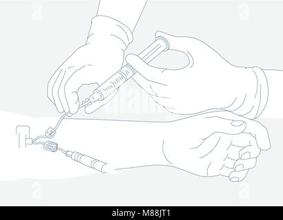 Mono line illustration of a diagram illustrating infusion therapy by ...