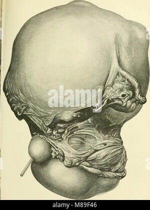 Fibroids and allied tumours (myoma and adenomyoma) - their pathology, clinical features and surgical treatment (1918) (14593929400) Stock Photo