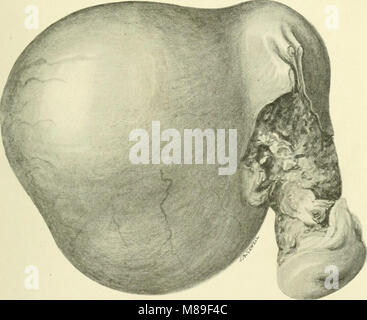 Fibroids and allied tumours (myoma and adenomyoma) - their pathology, clinical features and surgical treatment (1918) (14757631416) Stock Photo