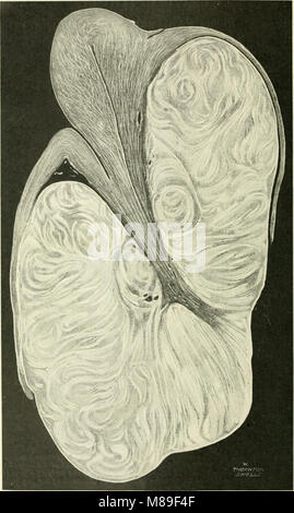 Fibroids and allied tumours (myoma and adenomyoma) - their pathology, clinical features and surgical treatment (1918) (14777495311) Stock Photo