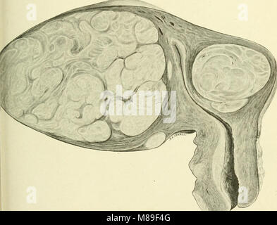 Fibroids and allied tumours (myoma and adenomyoma) - their pathology, clinical features and surgical treatment (1918) (14778264464)
