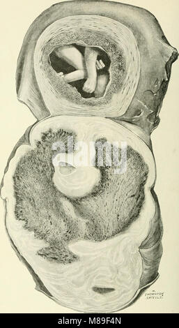 Fibroids and allied tumours (myoma and adenomyoma) - their pathology, clinical features and surgical treatment (1918) (14780601995) Stock Photo