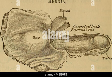 Hernia, strangulated and reducible. With cure by subcutaneous injections, together with sugcested (!) and improved methods for kelotomy. Also an appendix giving a short account of various new surgical (14580354210) Stock Photo