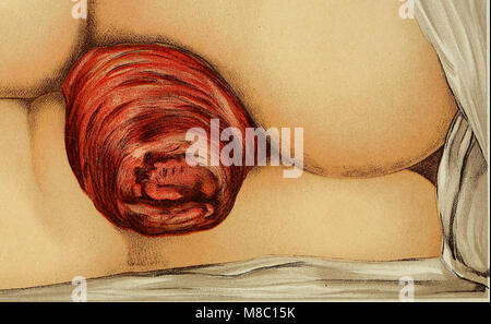 Diseases of the rectum and anus- designed for students and practitioners of medicine (1910) (14598035438) Stock Photo