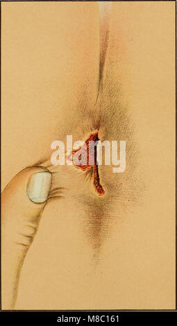 Diseases of the rectum and anus- designed for students and practitioners of medicine (1910) (14782310884) Stock Photo