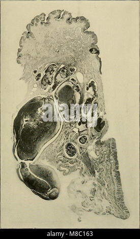 Diseases of the rectum and anus- designed for students and practitioners of medicine (1910) (14784336522) Stock Photo