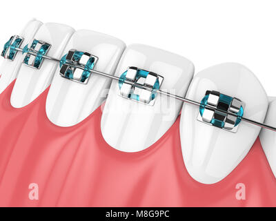 3d render of jaw with teeth and orthodontic braces over white background Stock Photo