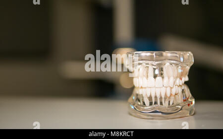 Close up of an upper and lower jaw model used in dentistry as an educational tool. Model shows implants and diseased teeth. Stock Photo