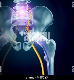 Sciatica pain symptoms and diagnosis medical concept as a disease causing physical problems with 3D illustration elements Stock Photo