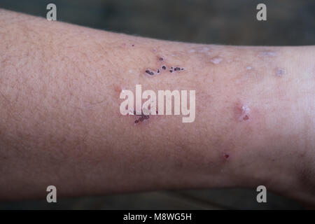 Wound leg, Diabetic foot syndrome. Gangrene of the leg. Stock Photo