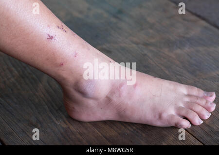 Wound leg, Diabetic foot syndrome. Gangrene of the leg. Stock Photo