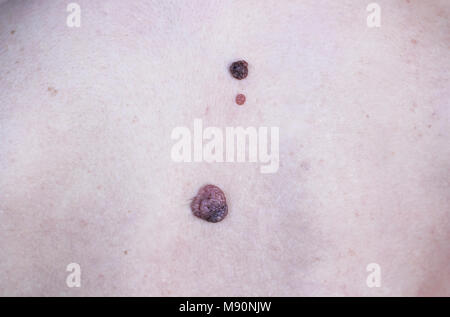 Big moles on back of woman close up, macro photo Stock Photo