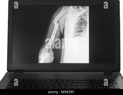 X-ray image of broken arm on monitor of pc on the white background. Stock Photo