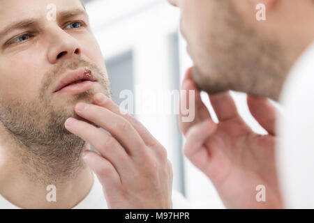 Young man suffering from painful herpes on his mouth Stock Photo