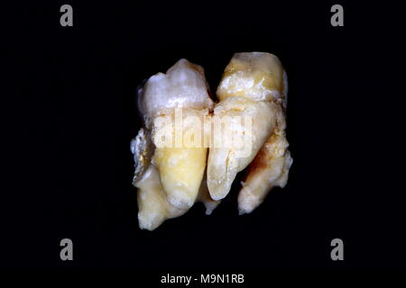 tooth fusion or gemination or concrescence ??? Stock Photo