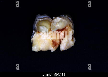 tooth fusion or gemination or concrescence ??? Stock Photo