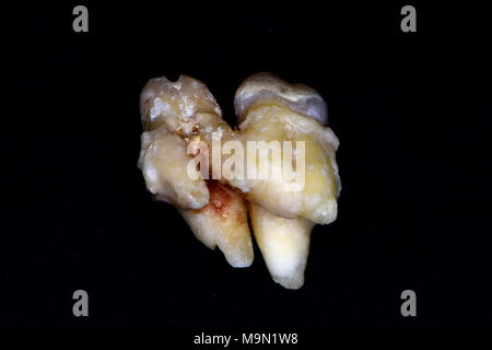 tooth fusion or gemination or concrescence ??? Stock Photo