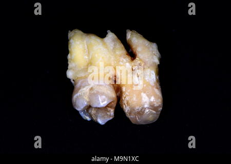 tooth fusion or gemination or concrescence ??? Stock Photo