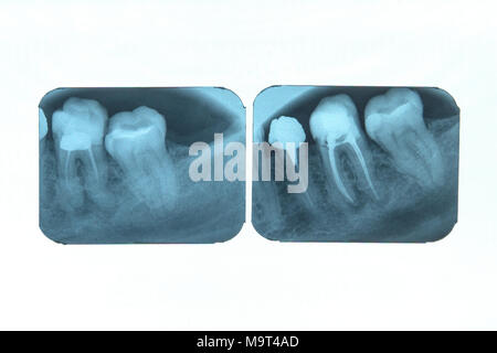 photo X-ray images on the x-ray film depicts the roots of the teeth of the chewing group are sealed after endodontic treatment Stock Photo