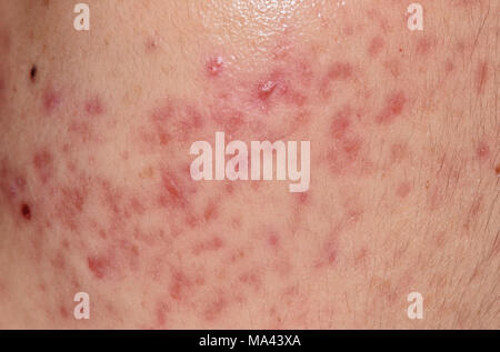 closeup skin problems, nodular cystic acne skin Stock Photo