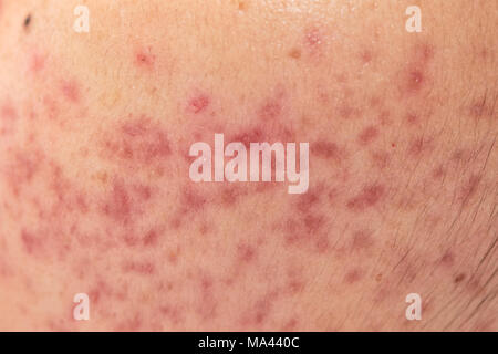 closeup skin problems, nodular cystic acne skin Stock Photo