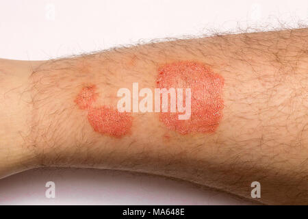 Psoriasis. Alergic rashes on the skin close up. The concept of treating the disease Stock Photo