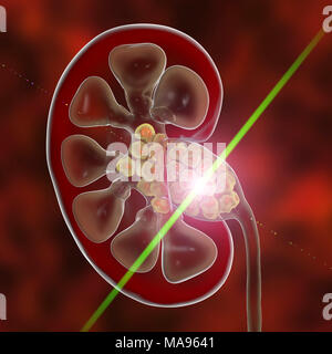 Lithotripsy kidney stone treatment, conceptual illustration. Kidney stones are deposits of calcium and other minerals in the kidneys and ureters. They can be treated by breaking up the stones using pulses of ultrasound. Stock Photo