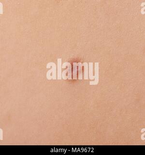 Mole on skin, close up. Stock Photo