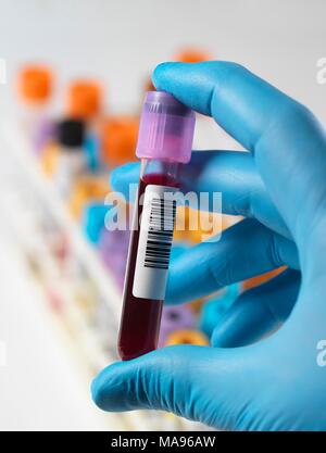 MODEL RELEASED. Technician holding a blood sample with a variety of human samples in a rack awaiting clinical testing. Stock Photo