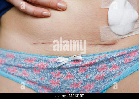 Woman showing her scar after a surgery. C section, fibroids operation. Stock Photo