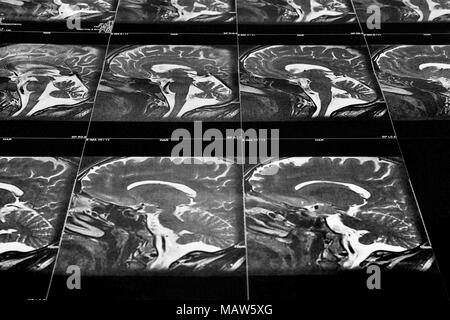 Perspective view of a MRI scan of the human brain (sagittal view) Stock Photo