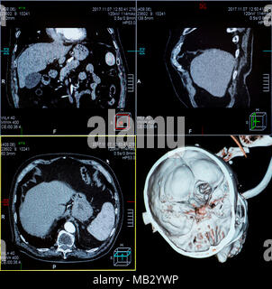 Magnetic resonance imaging (MRI) scan - CT scans of human head on a ultrasound computer monitor. Stock Photo