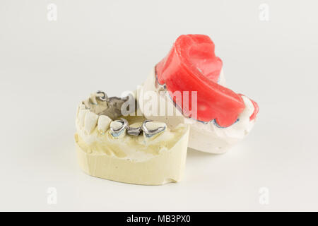 wax rollers on the tooth model for determining jaw closure Stock Photo