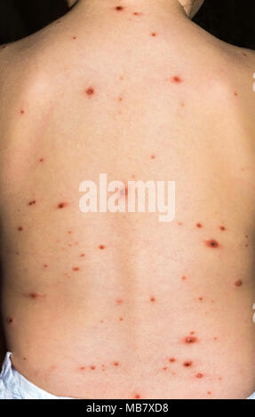 Close up shot of varicella virus or chicken pox bubble rash and blister on baby's back with crust. Dermatology concept. Stock Photo