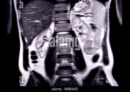 Ride through the human abdomen and chest by means of 18 MRI cuts (coronal view). Picture 9/18 Stock Photo