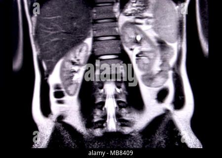 Ride through the human abdomen and chest by means of 18 MRI cuts (coronal view). Picture 10/18 Stock Photo