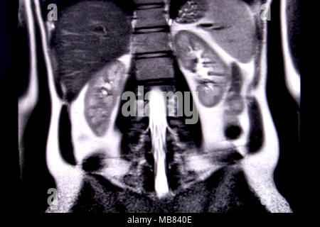 Ride through the human abdomen and chest by means of 18 MRI cuts (coronal view). Picture 11/18 Stock Photo
