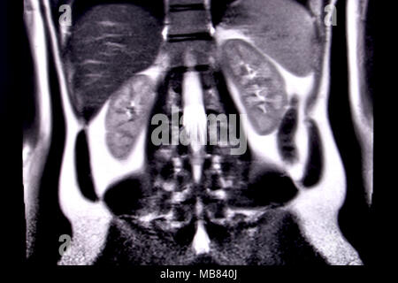 Ride through the human abdomen and chest by means of 18 MRI cuts (coronal view). Picture 12/18 Stock Photo