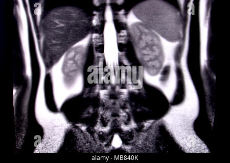 Ride through the human abdomen and chest by means of 18 MRI cuts (coronal view). Picture 13/18 Stock Photo